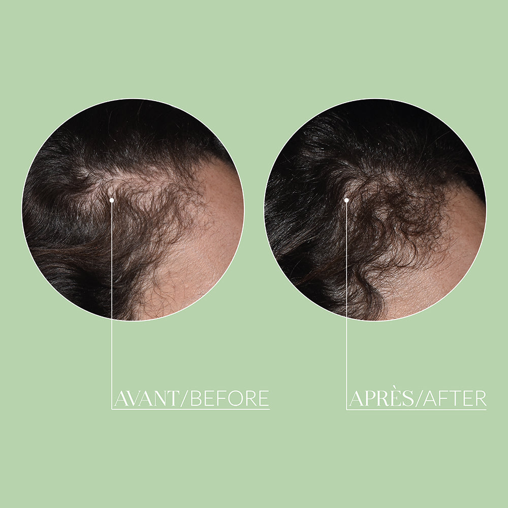 MESO’ME HAIR - Mesotherapy Hair Loss Treatment