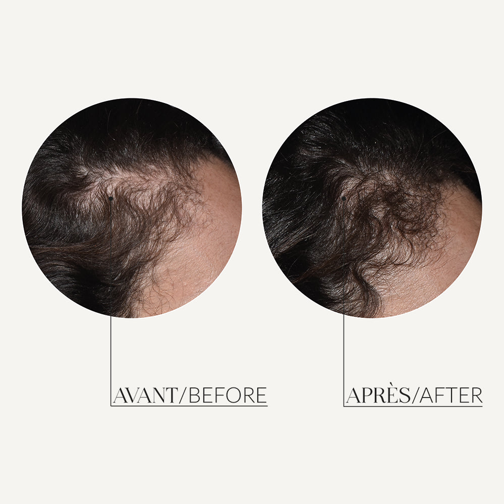 MESO’ME HAIR - Mesotherapy Hair Loss Treatment