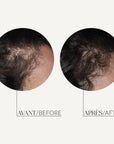 MESO’ME HAIR - Mesotherapy Hair Loss Treatment